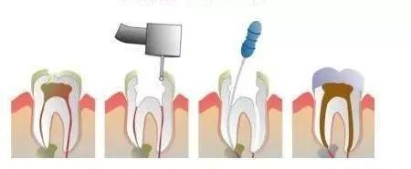口腔名医站 | 为什么补牙需要将牙洞磨得更大？