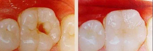 口腔名医站 | 为什么补牙需要将牙洞磨得更大？