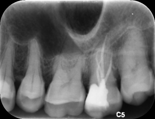 口腔名医站| 根管治疗后，牙齿依然酸痛？原来是漏了“它”