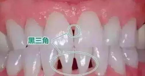 口腔名医站 | 你是否留意到了牙齿上那个呈现出“黑三角”形状的区域？