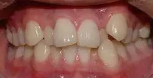 口腔名医站 | 你是否留意到了牙齿上那个呈现出“黑三角”形状的区域？