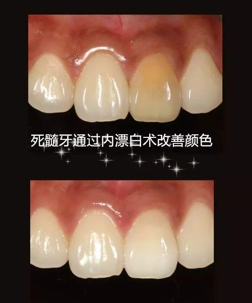口腔名医站:如何处理牙齿黄问题？专家有话要说